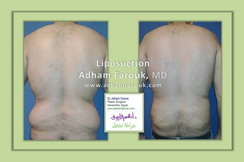 Dr. Adham Farouk - Body Sculpture Before and After Transformation Case 2
