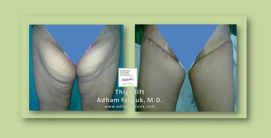 Dr. Adham Farouk - Body Sculpture Before and After Transformation Case 3