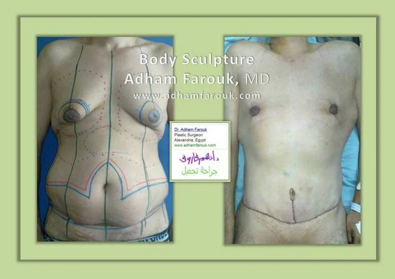 Dr. Adham Farouk - Body Sculpture Before and After Transformation Case 4
