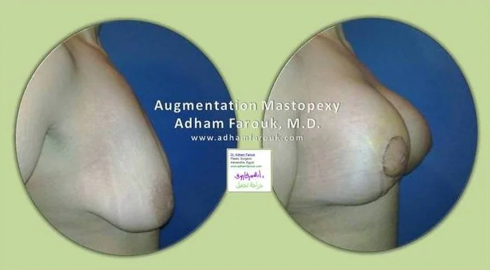 Dr. Adham Farouk - Breast Surgery Before and After Transformation Case 1