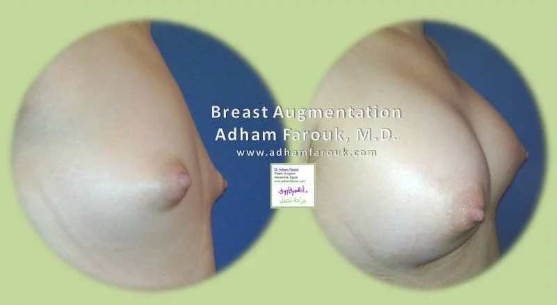 Dr. Adham Farouk - Breast Surgery Before and After Transformation Case 2