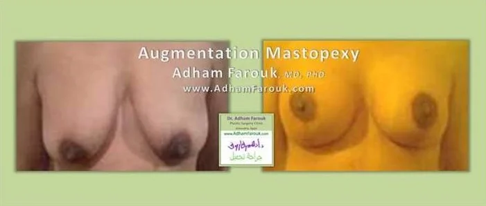 Dr. Adham Farouk - Breast Surgery Before and After Transformation Case 4