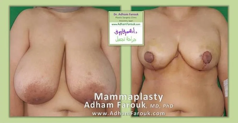 Dr. Adham Farouk - Breast Surgery Before and After Transformation Case 6
