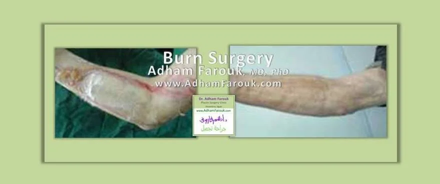 Dr. Adham Farouk - Burns Before and After Transformation Case 1