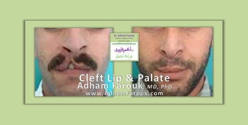 Dr. Adham Farouk - Cleft Lip Before and After Transformation Case 2