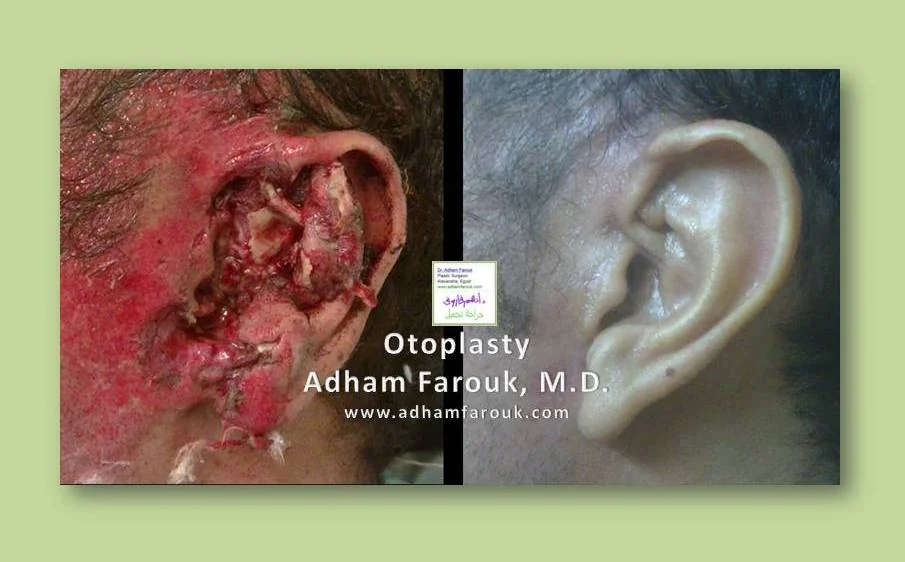 Dr. Adham Farouk - Ear Surgery Before and After Transformation Case 4