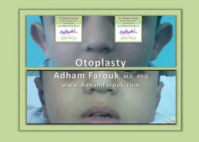Dr. Adham Farouk - Ear Surgery Before and After Transformation Case 6