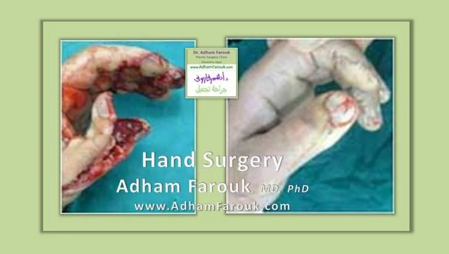 Dr. Adham Farouk - Hand Surgery Before and After Transformation Case 2