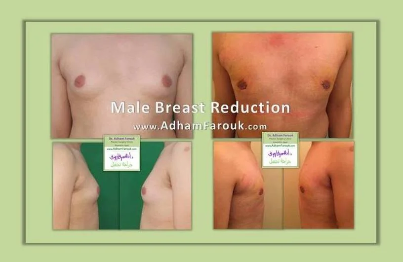 Dr. Adham Farouk - Male Breast Surgery Before and After Transformation Case 2