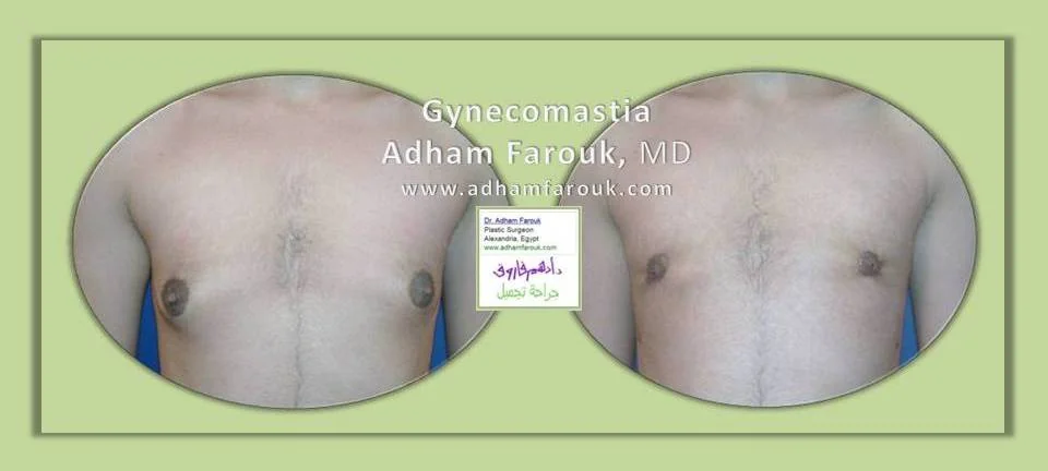 Dr. Adham Farouk - Male Breast Surgery Before and After Transformation Case 3
