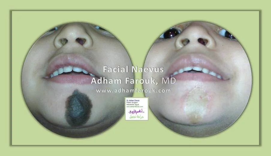 Dr. Adham Farouk - Nevus Removal Before and After Transformation Case 1