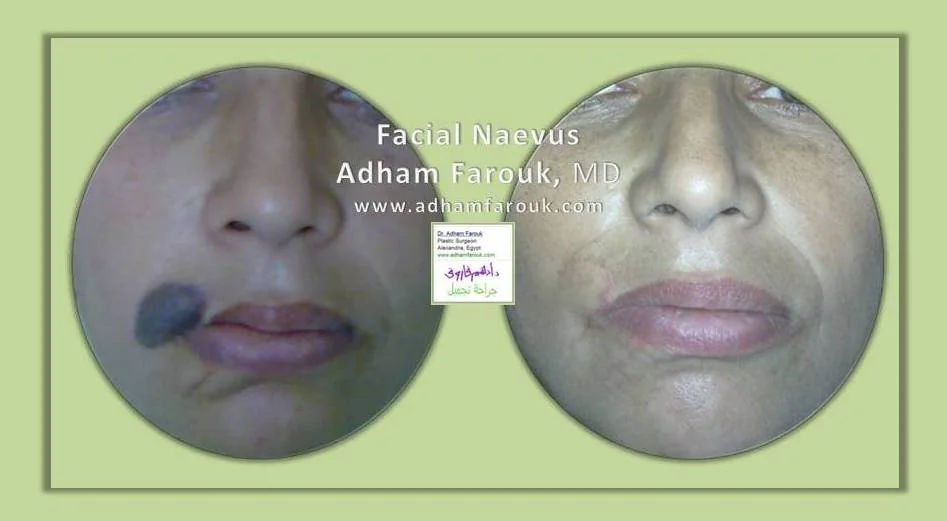 Dr. Adham Farouk - Nevus Removal Before and After Transformation Case 2