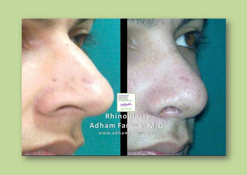 Dr. Adham Farouk - Rhinoplasty Before and After Transformation Case 2