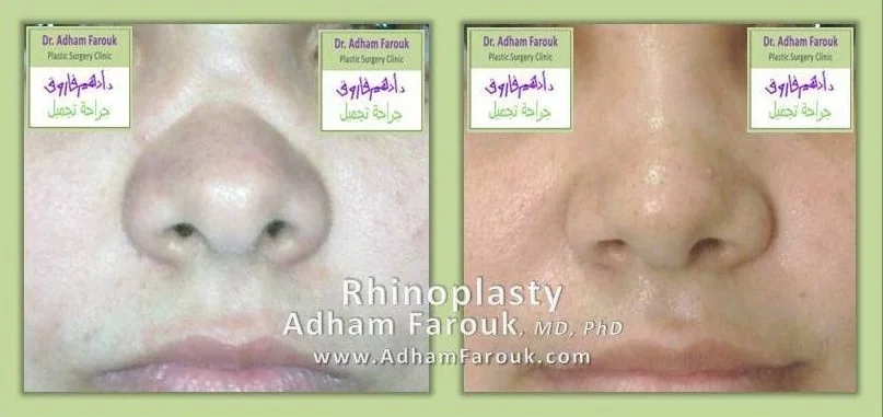 Dr. Adham Farouk - Rhinoplasty Before and After Transformation Case 3