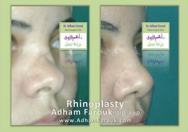 Dr. Adham Farouk - Rhinoplasty Before and After Transformation Case 4
