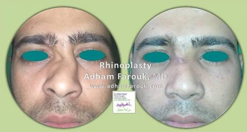 Dr. Adham Farouk - Rhinoplasty Before and After Transformation Case 5
