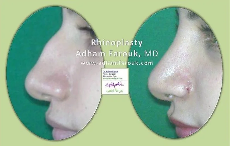 Dr. Adham Farouk - Rhinoplasty Before and After Transformation Case 7