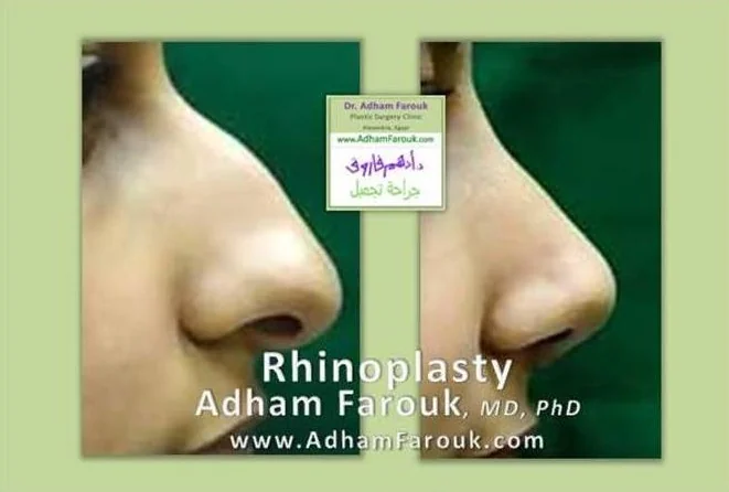 Dr. Adham Farouk - Rhinoplasty Before and After Transformation Case 8