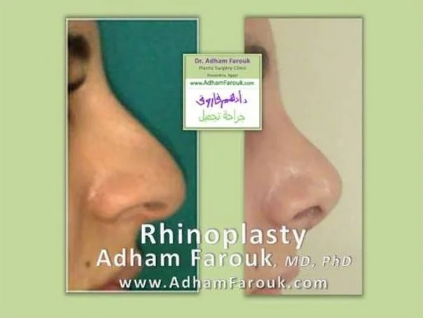 Dr. Adham Farouk - Rhinoplasty Before and After Transformation Case 9