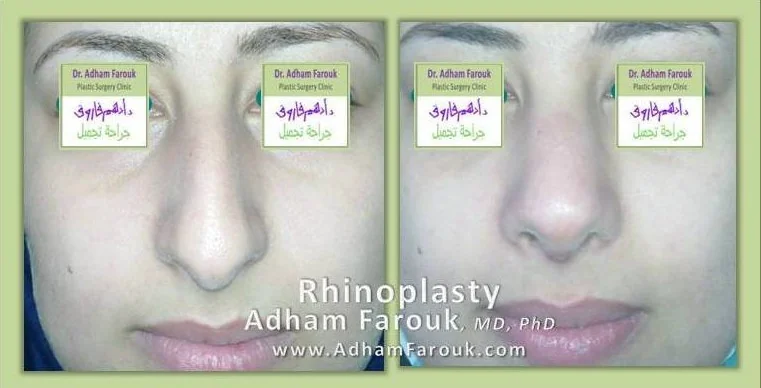 Dr. Adham Farouk - Rhinoplasty Before and After Transformation Case 12