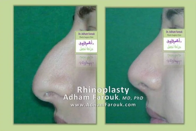 Dr. Adham Farouk - Rhinoplasty Before and After Transformation Case 13