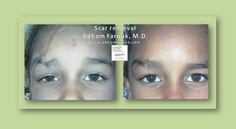 Dr. Adham Farouk - Scars & Scalp Before and After Transformation Case 1