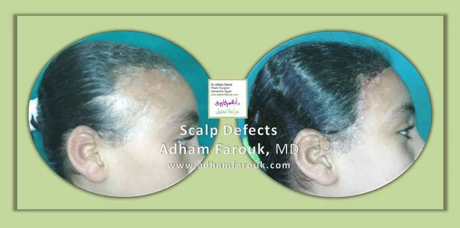 Dr. Adham Farouk - Scars & Scalp Before and After Transformation Case 2