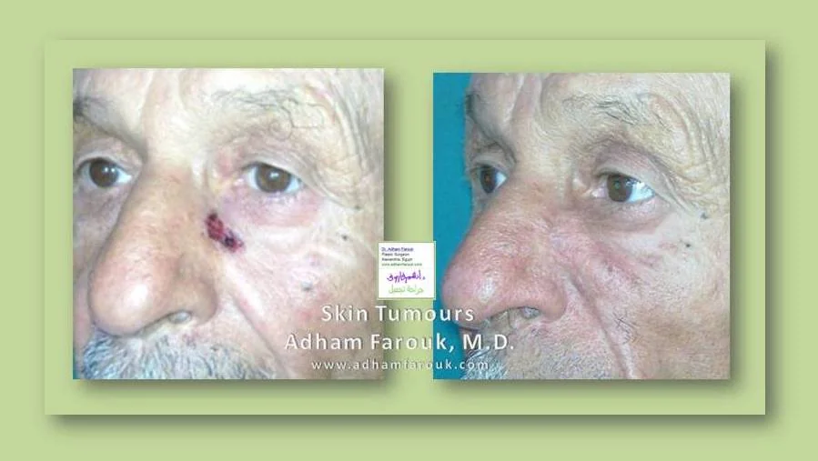 Dr. Adham Farouk - Tumor Surgery Before and After Transformation Case 1