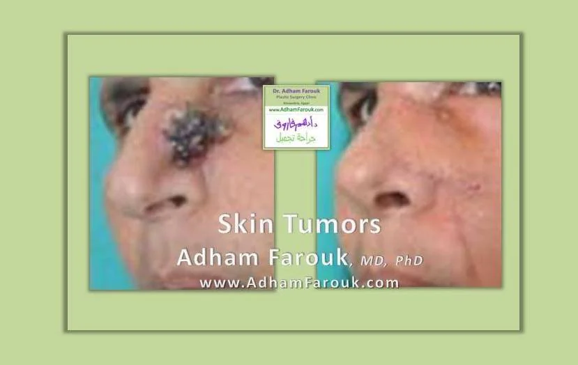 Dr. Adham Farouk - Tumor Surgery Before and After Transformation Case 2