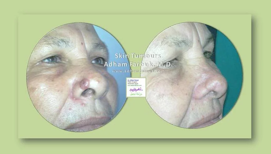 Dr. Adham Farouk - Tumor Surgery Before and After Transformation Case 3