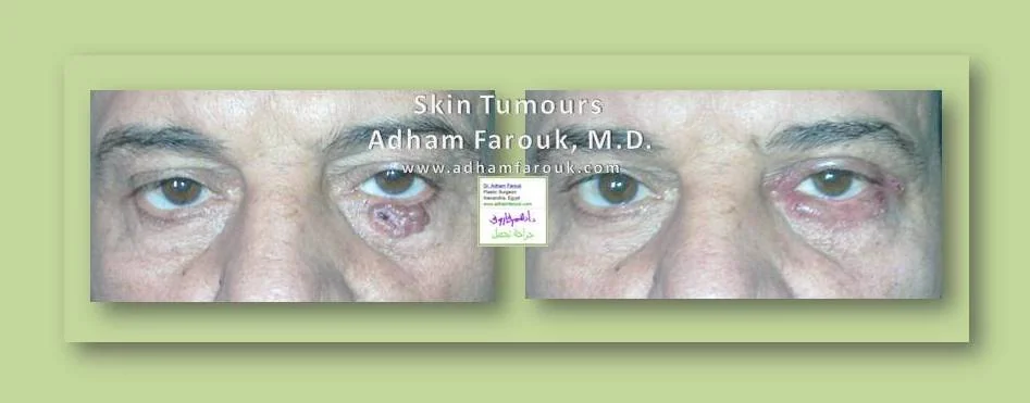 Dr. Adham Farouk - Tumor Surgery Before and After Transformation Case 4
